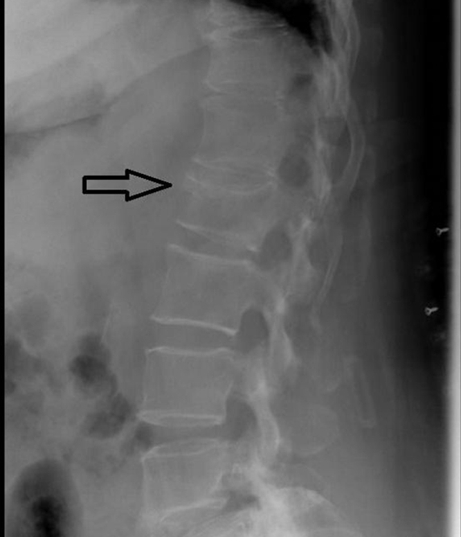 Лечение последствия компрессионного перелома позвоночника. Перелом 12 грудного позвонка рентген. Компрессионный перелом позвоночника л1. Перелом с7 позвонка рентген. Компрессионный перелом позвоночника тн3.